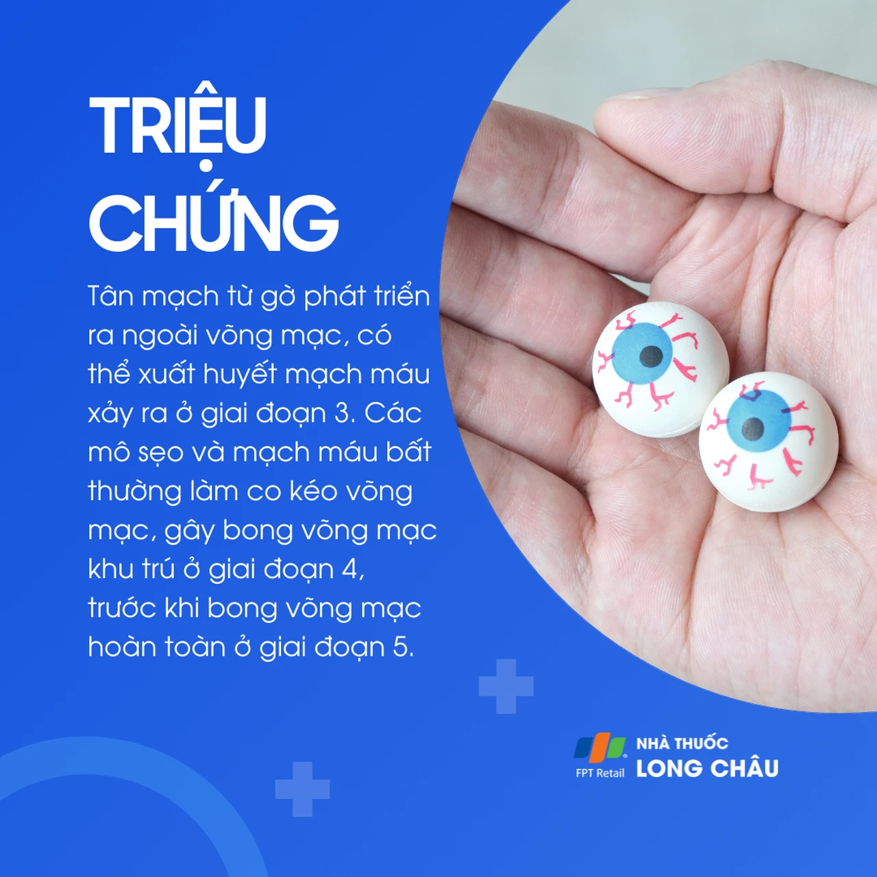 Bong võng mạc trẻ sinh non 3