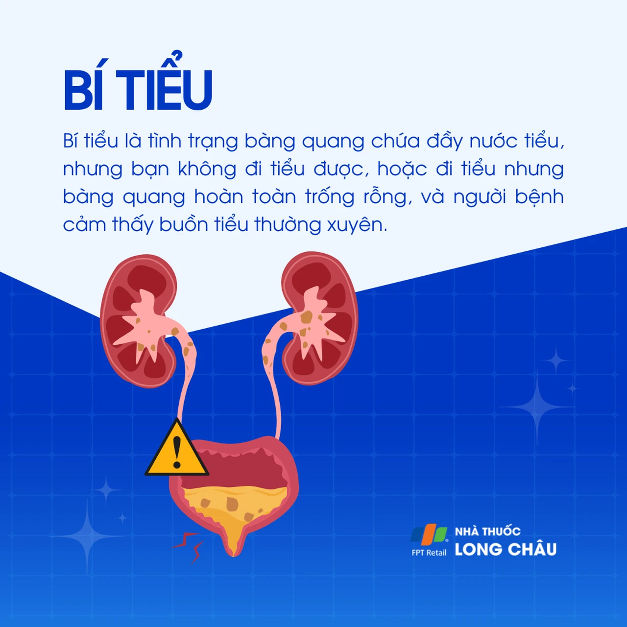 Bí tiểu: Là tình trạng bàng quang chứa đầy nước tiểu nhưng không đi tiểu được, hoặc đi tiểu xong vẫn còn tồn đọng nước tiểu