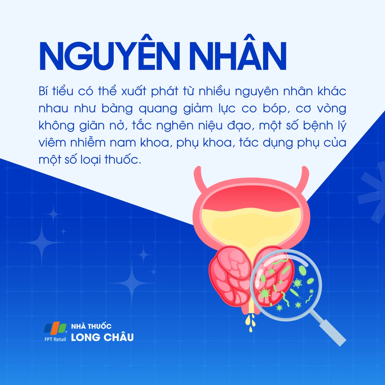 Nguyên nhân: Có thể do giảm lực co bóp bàng quang, cơ vòng không giãn, tắc nghẽn niệu đạo, bệnh lý viêm nhiễm nam – phụ khoa