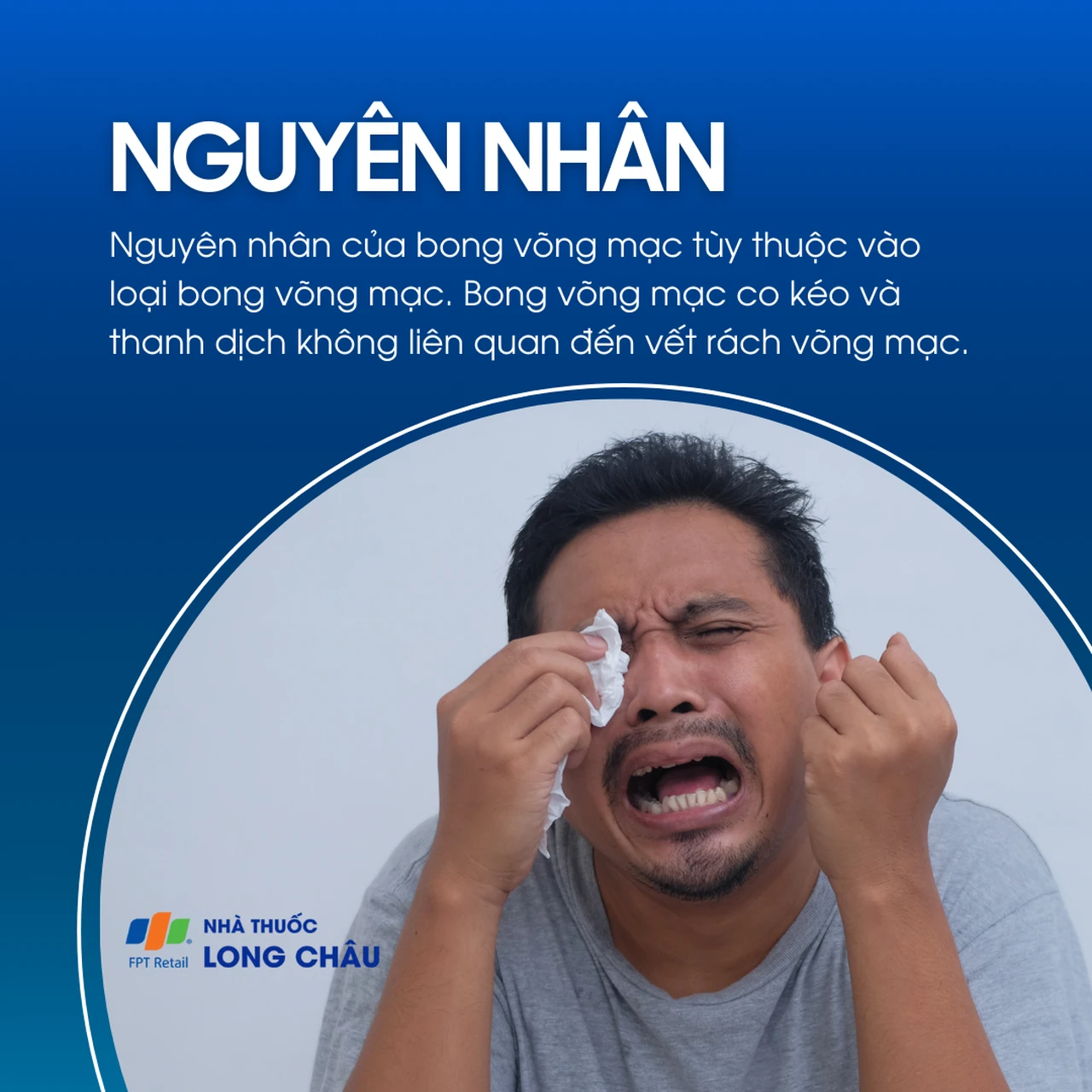 Do co kéo võng mạc, thanh dịch, không liên quan vết rách