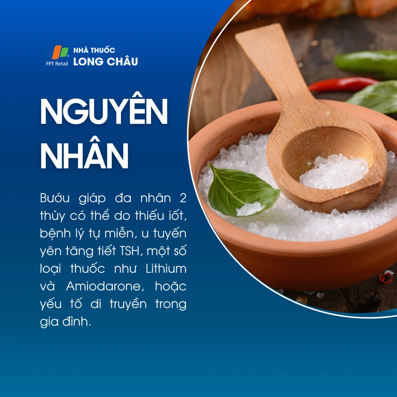 Bướu giáp đa nhân 2 thùy 3