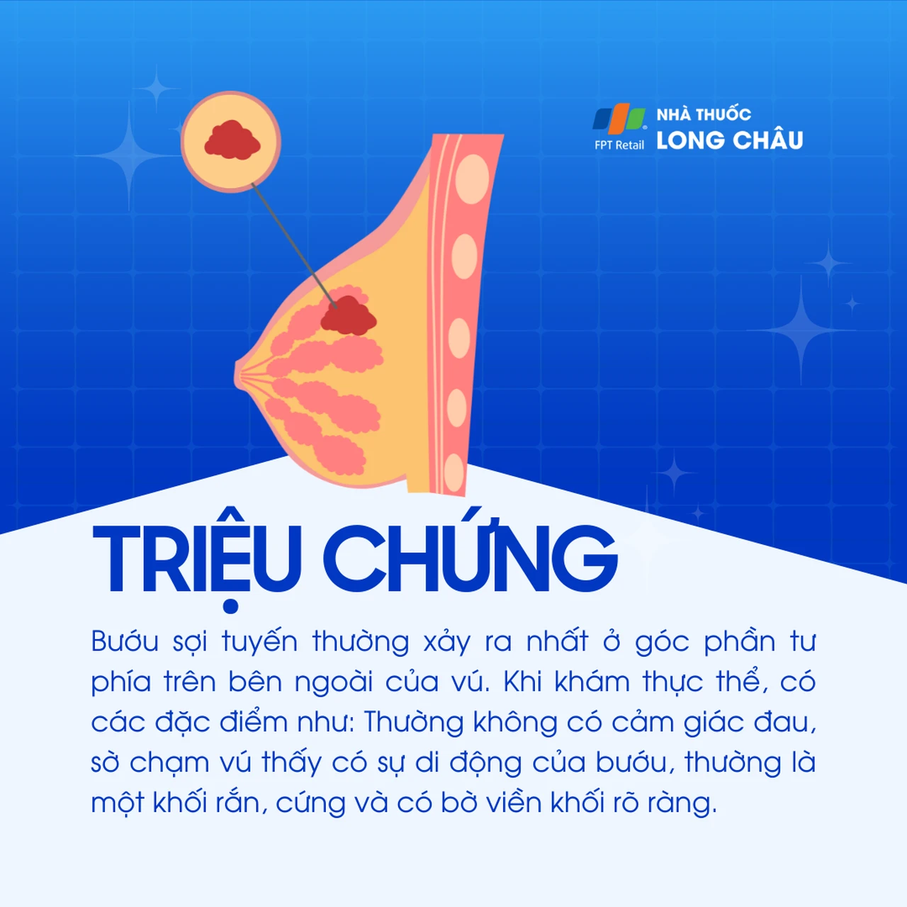 Bướu sợi tuyến vú Birads 3 2