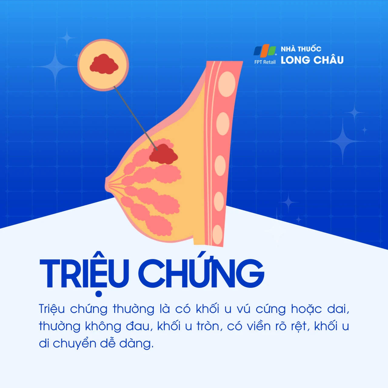 Bướu sợi tuyến vú Birads 3 2