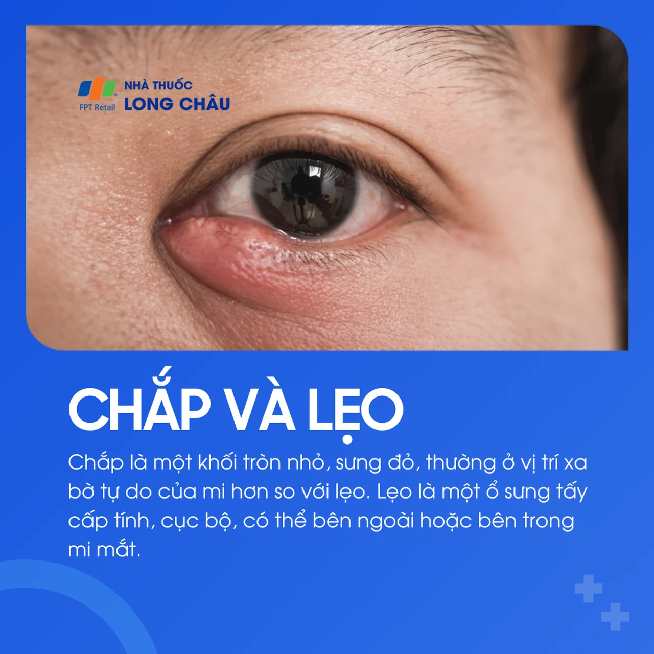 Chắp là khối tròn nhỏ, không nhiễm trùng. Lẹo là ổ viêm cấp tính, có thể bên trong hoặc bên ngoài mí mắt