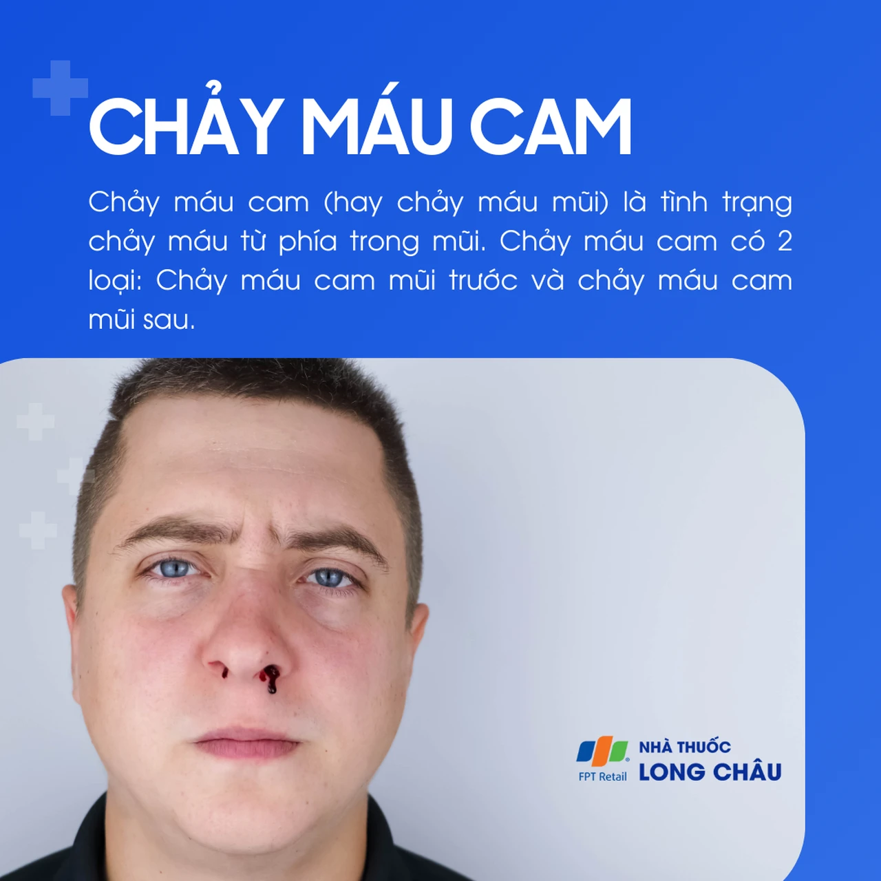 Chảy máu cam là tình trạng máu chảy ra từ mũi, thường chia thành chảy máu mũi trước và sau