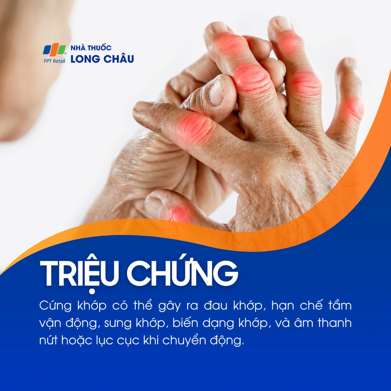 Cứng khớp gây đau, sưng, biến dạng khớp và có tiếng kêu khi vận động