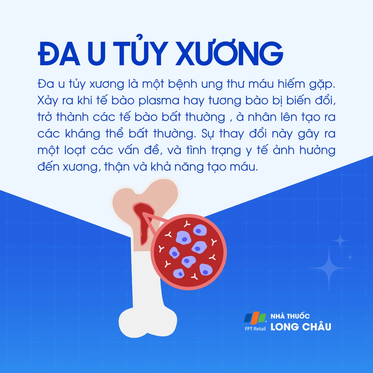Đa u tủy xương 1