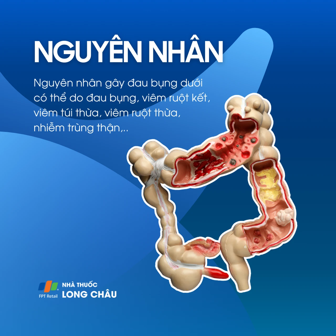 minh họa nguyên nhân gây đau bụng dưới như viêm ruột thừa, viêm túi thừa, viêm ruột kết