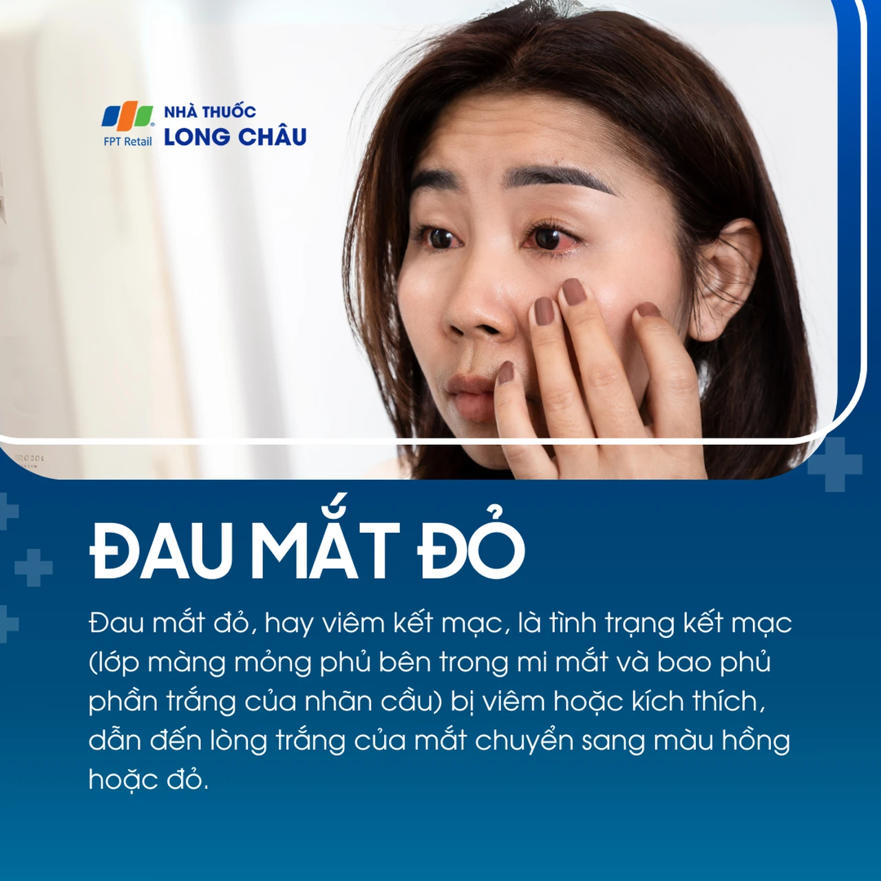 Đau mắt đỏ, viêm kết mạc khiến lòng trắng mắt chuyển màu đỏ