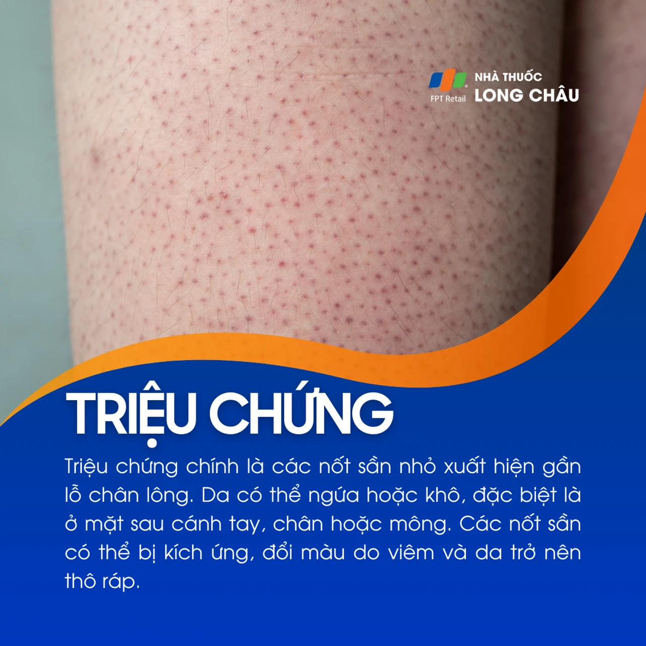 Dày sừng nang lông 2