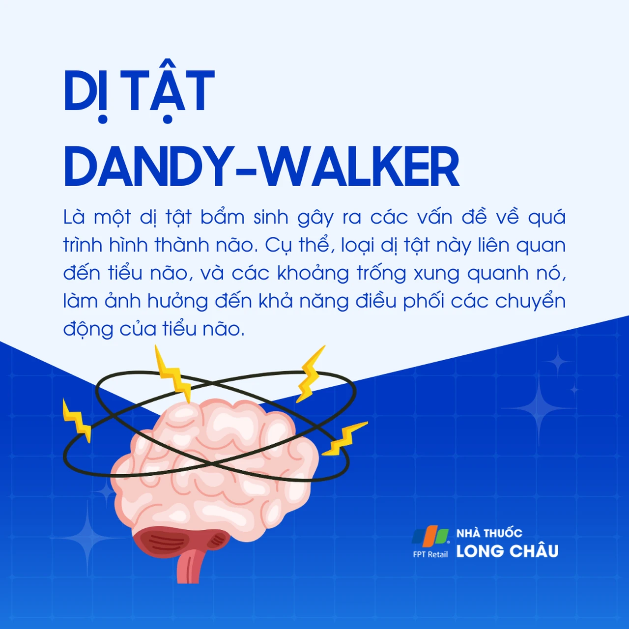 Dị tật Dandy-Walker 1