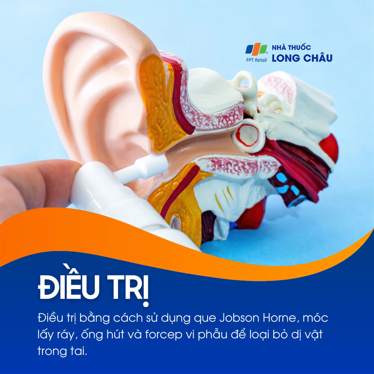 Dị vật trong tai 6