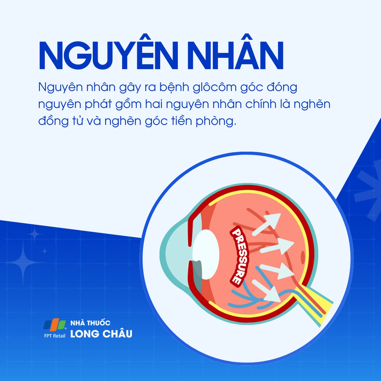 Glôcôm góc đóng nguyên phát 4