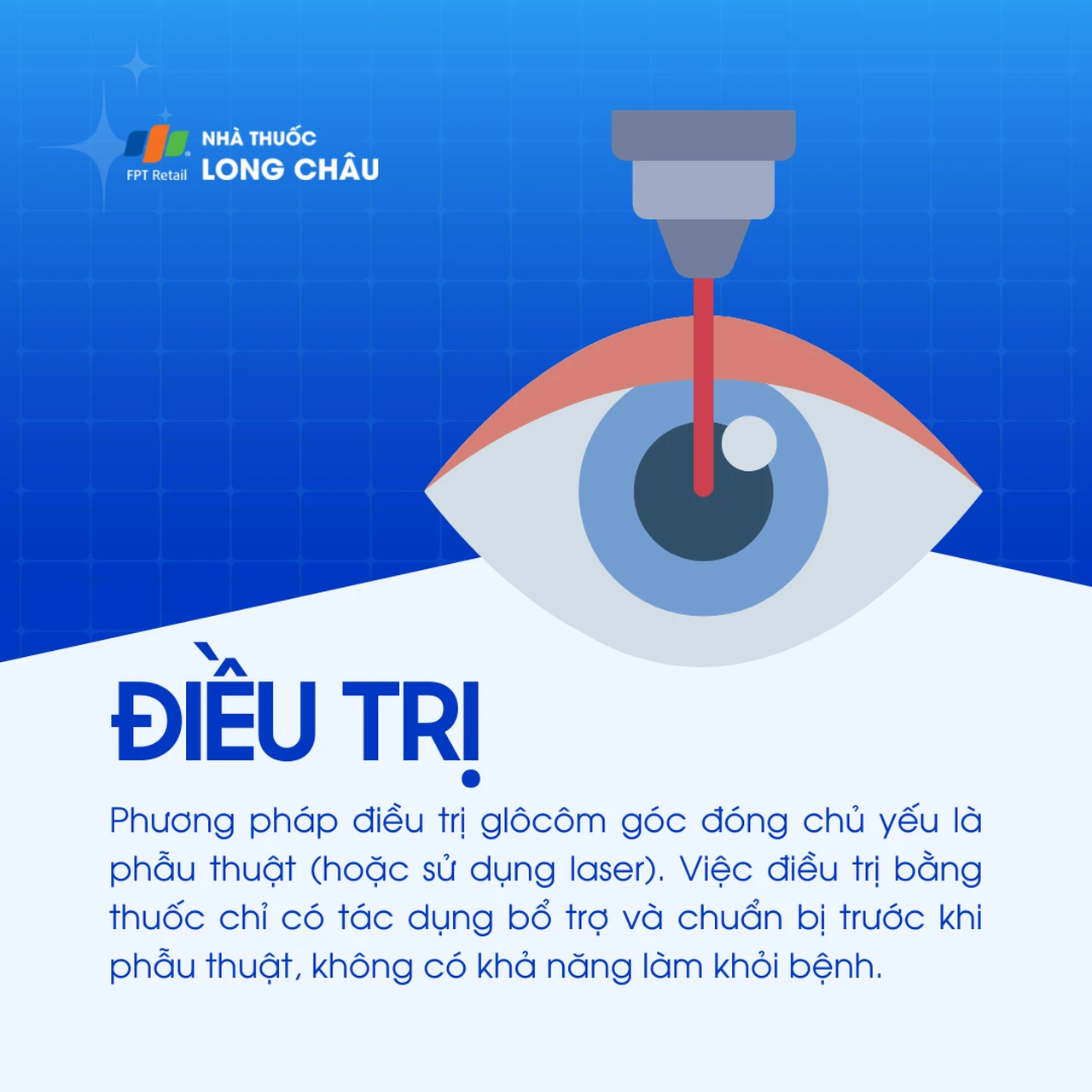 Glôcôm góc đóng nguyên phát 7