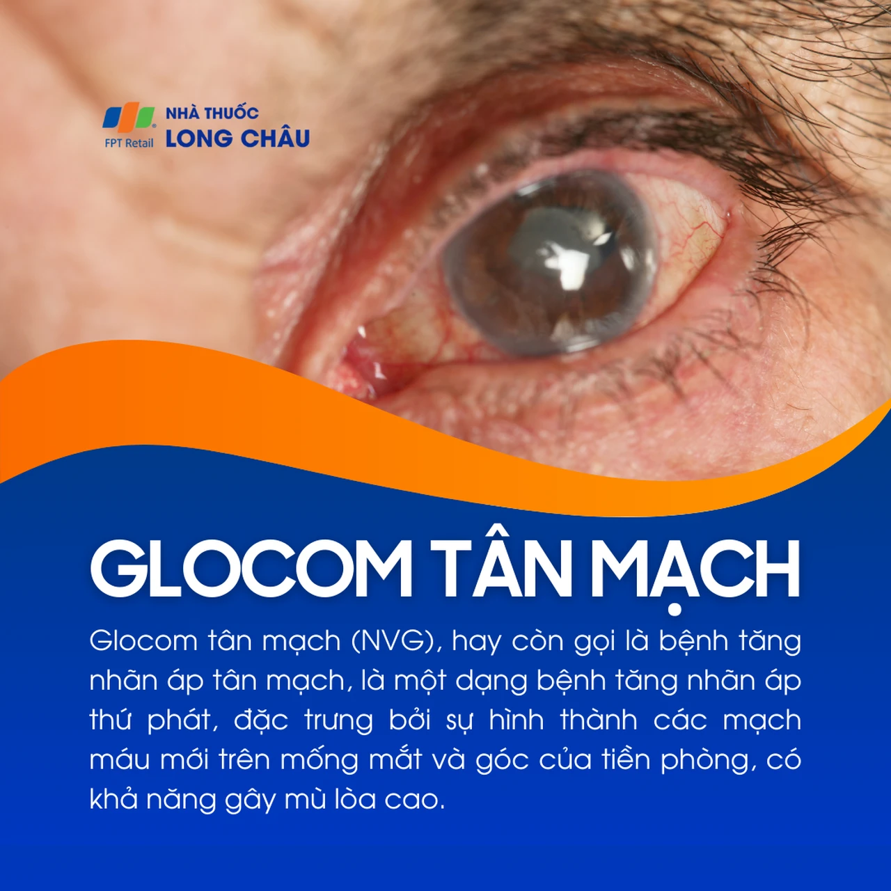 Glocom tân mạch 1