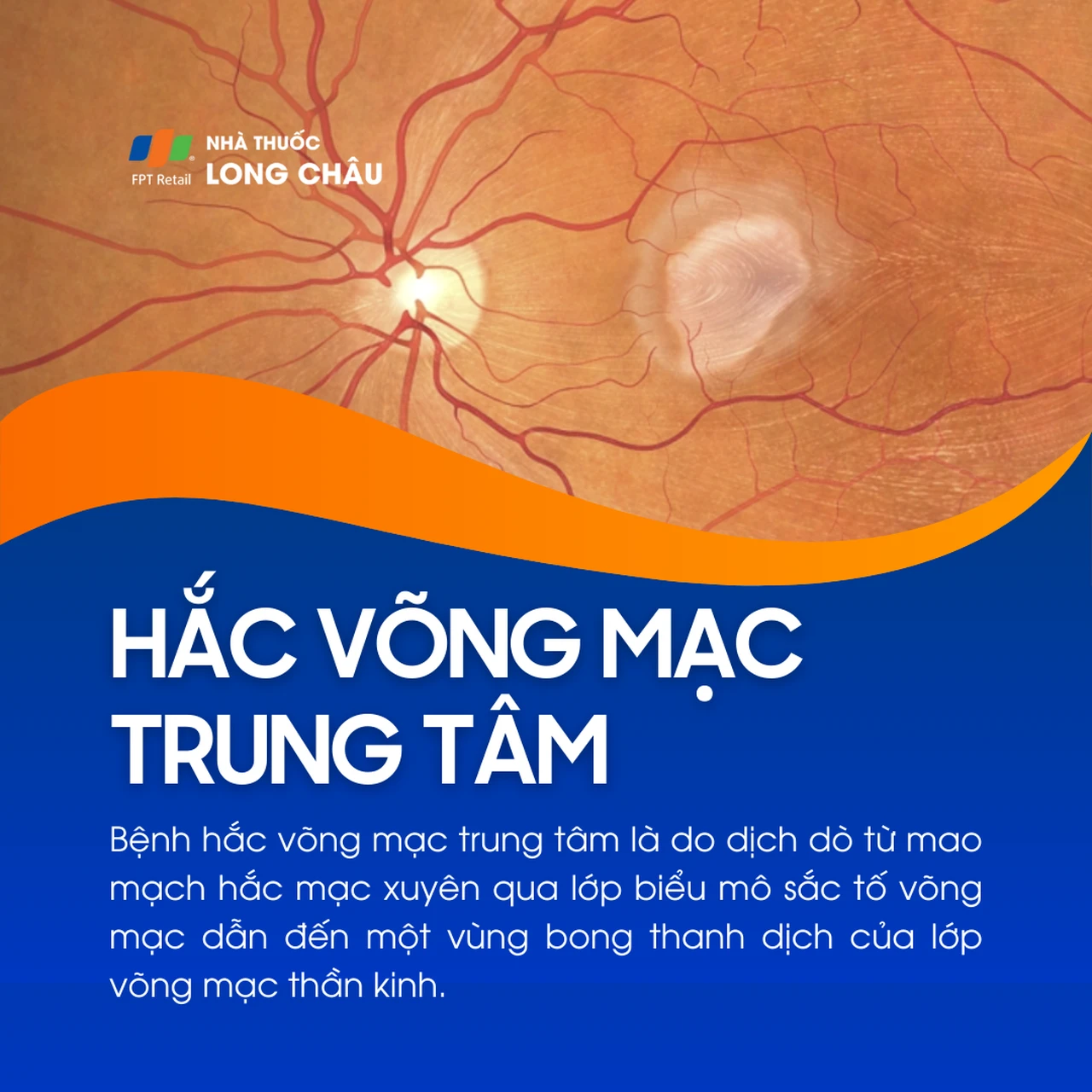 Hắc võng mạc trung tâm 1