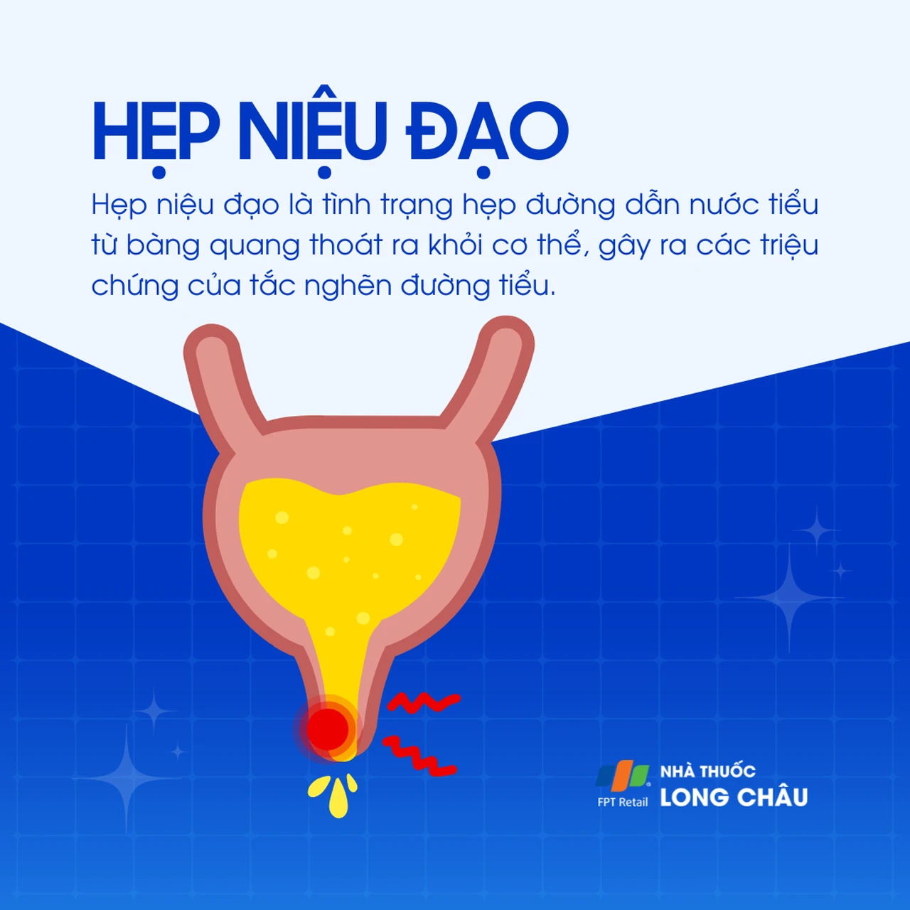 Hẹp niệu đạo 1