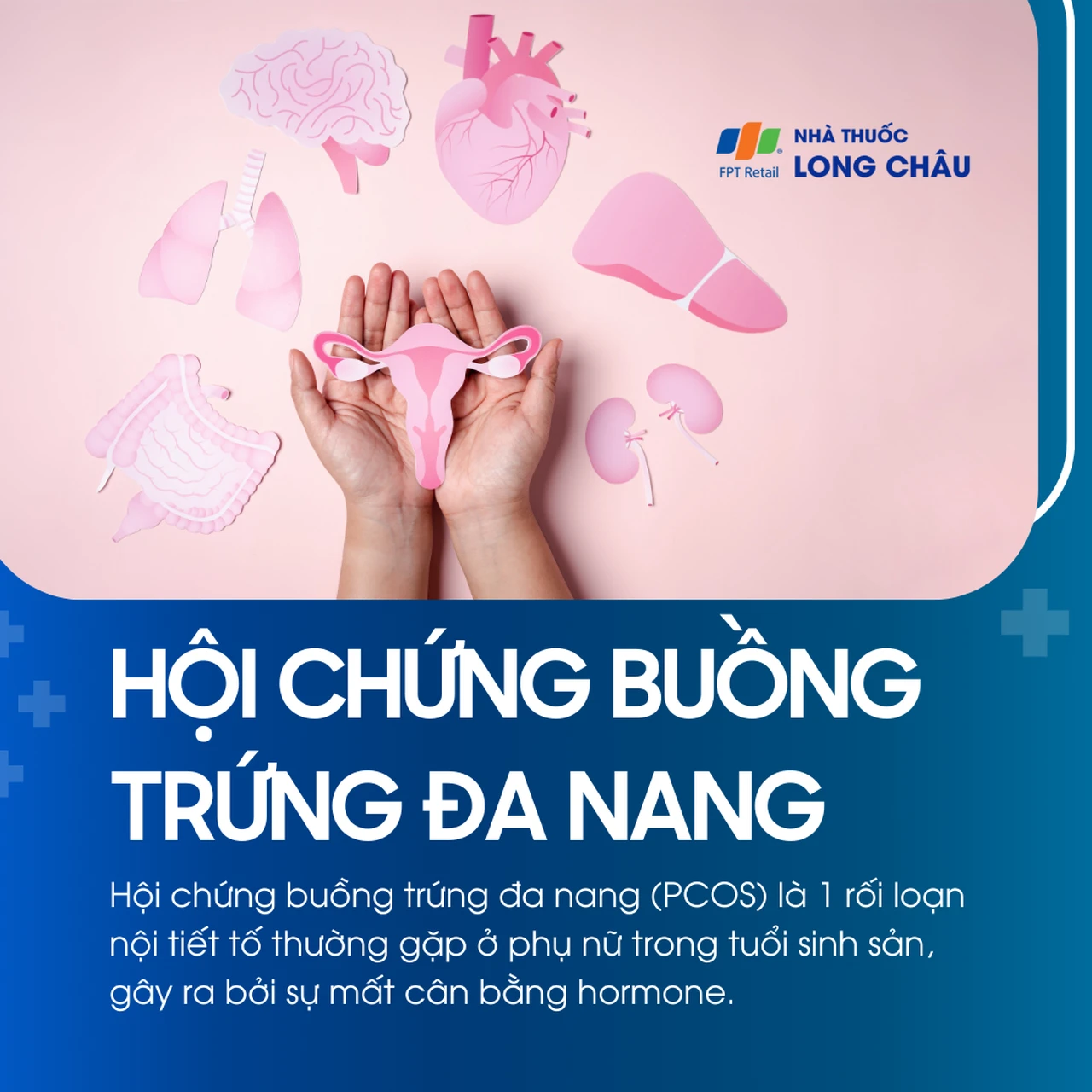 Hội chứng buồng trứng đa nang 1