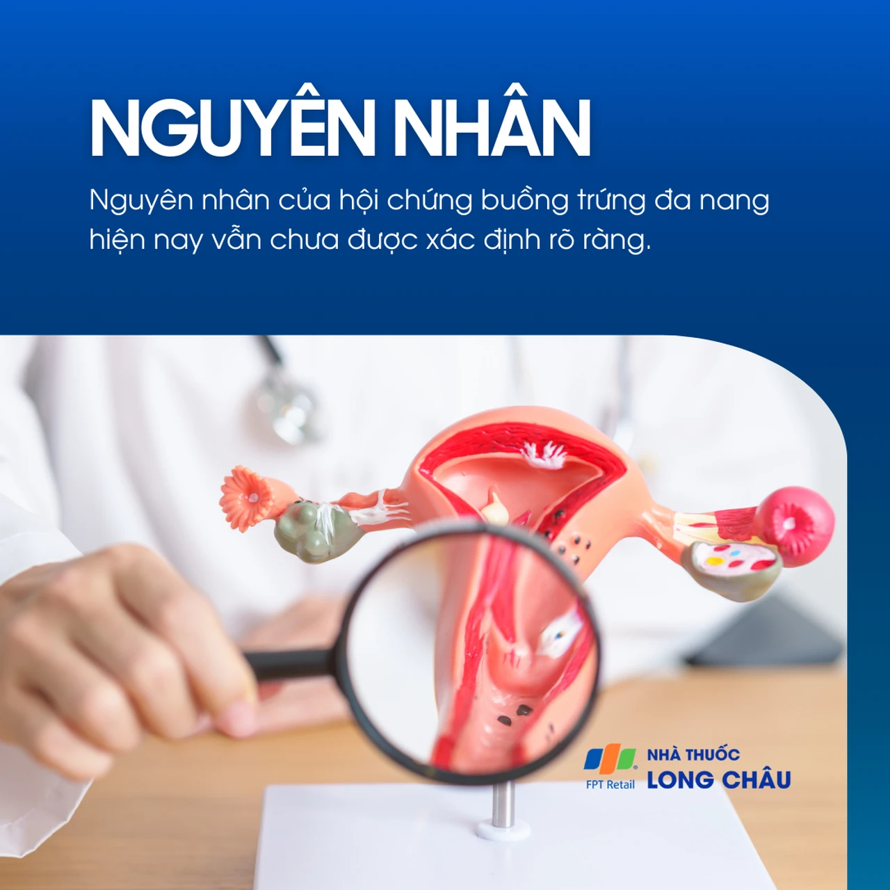 Hội chứng buồng trứng đa nang 3