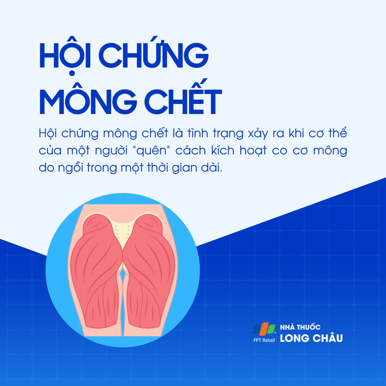Hội chứng mông chết 1