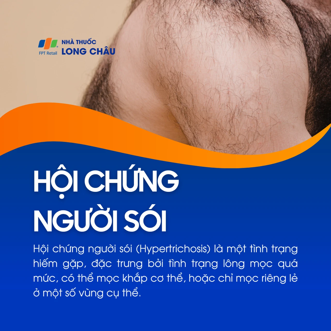 Hội chứng người sói 1