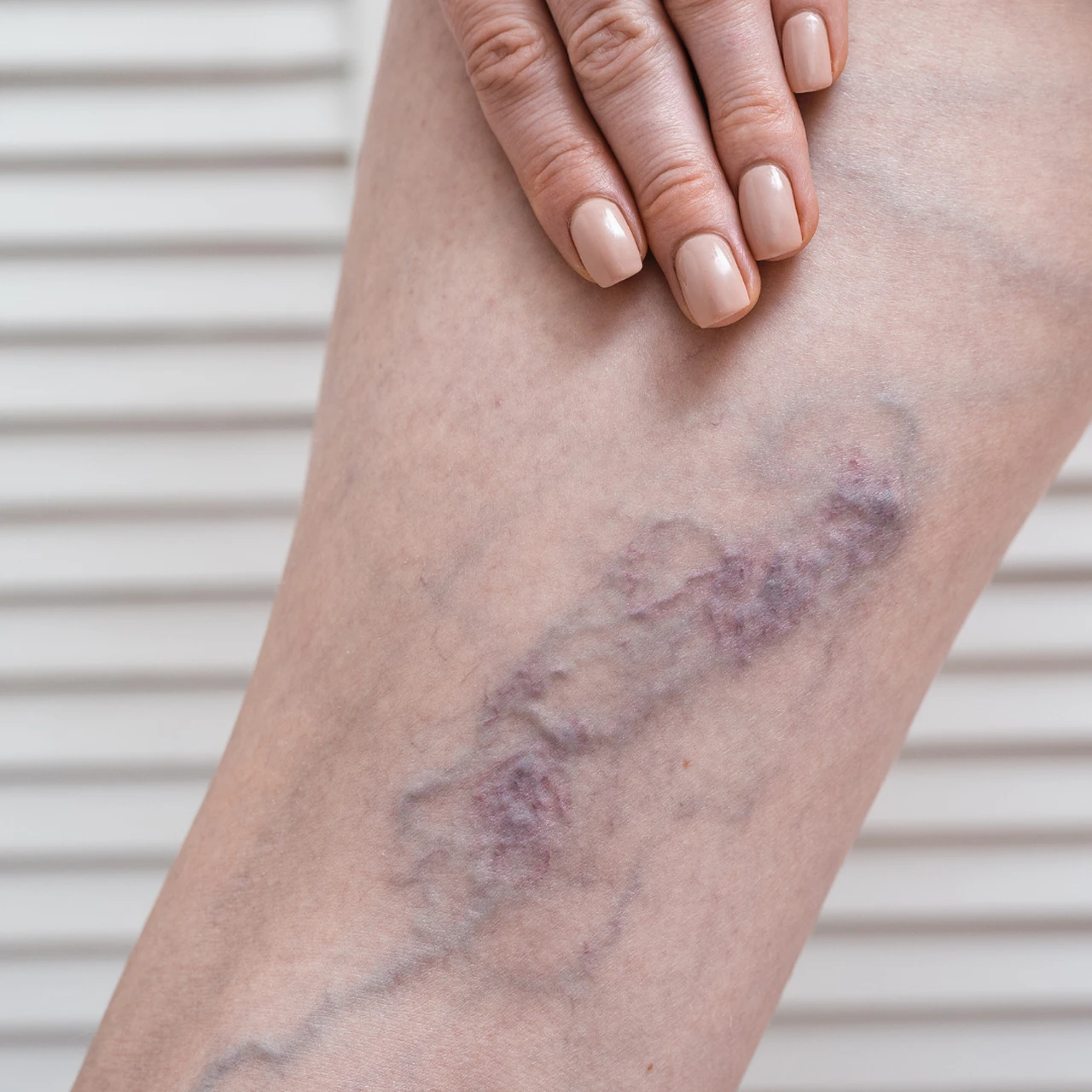 Huyết khối tĩnh mạch