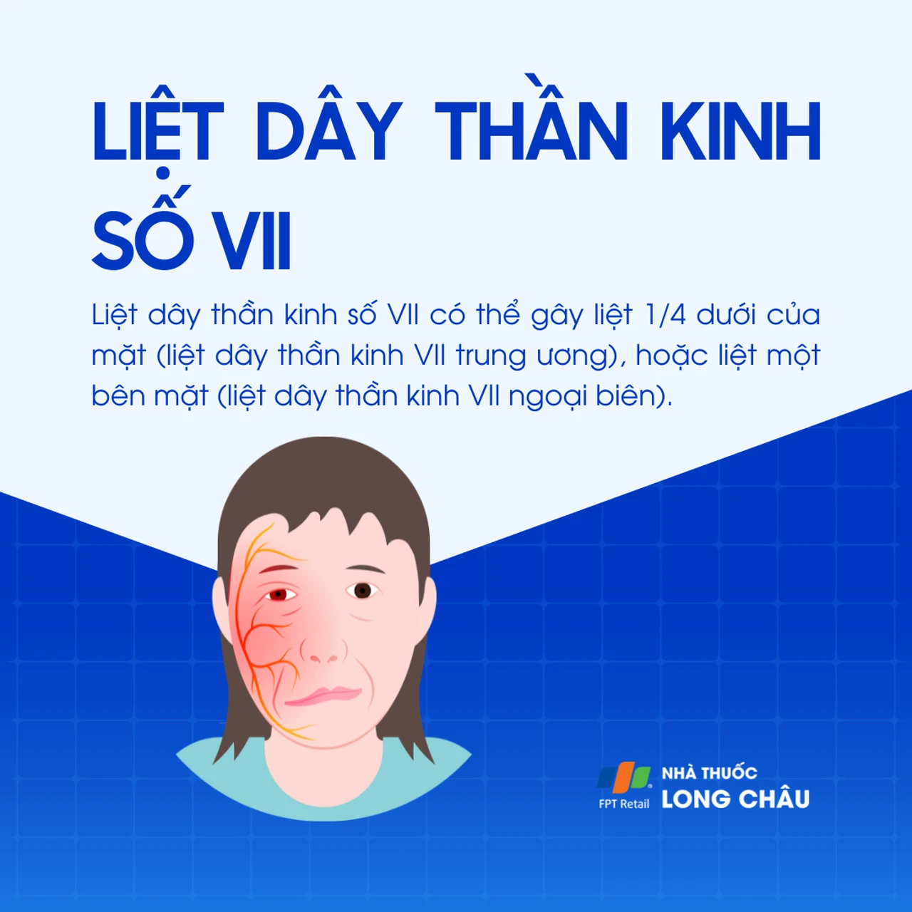 Liệt dây thần kinh số VII 1