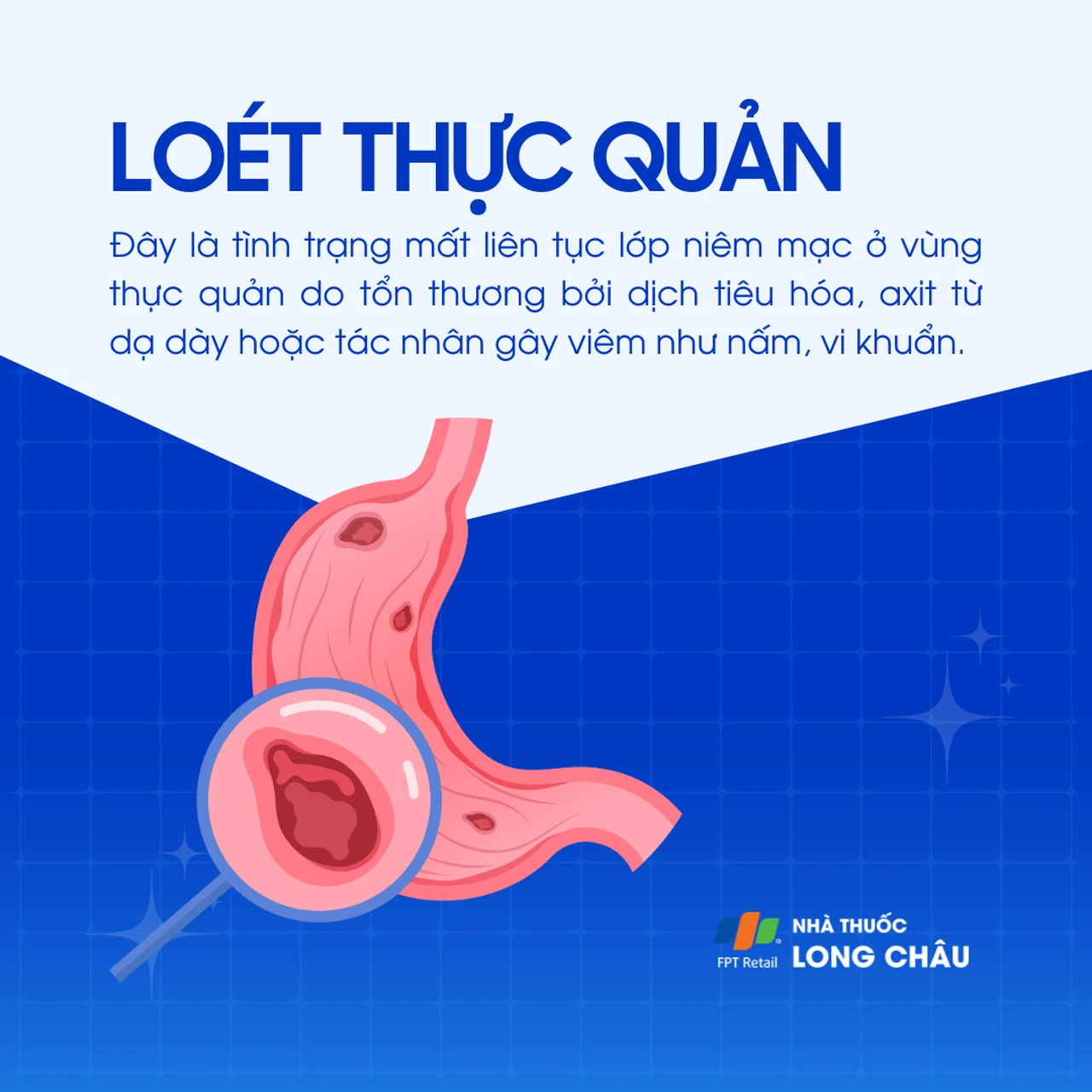 Loét thực quản 1