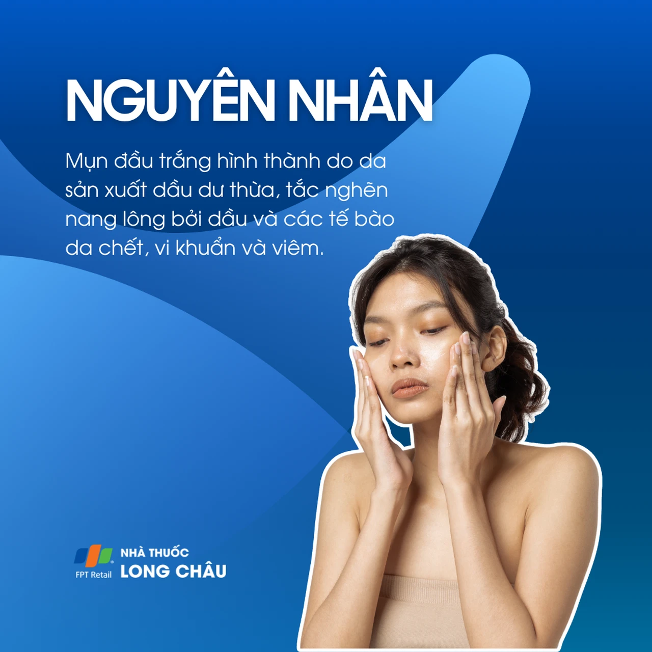 Mụn đầu trắng 3