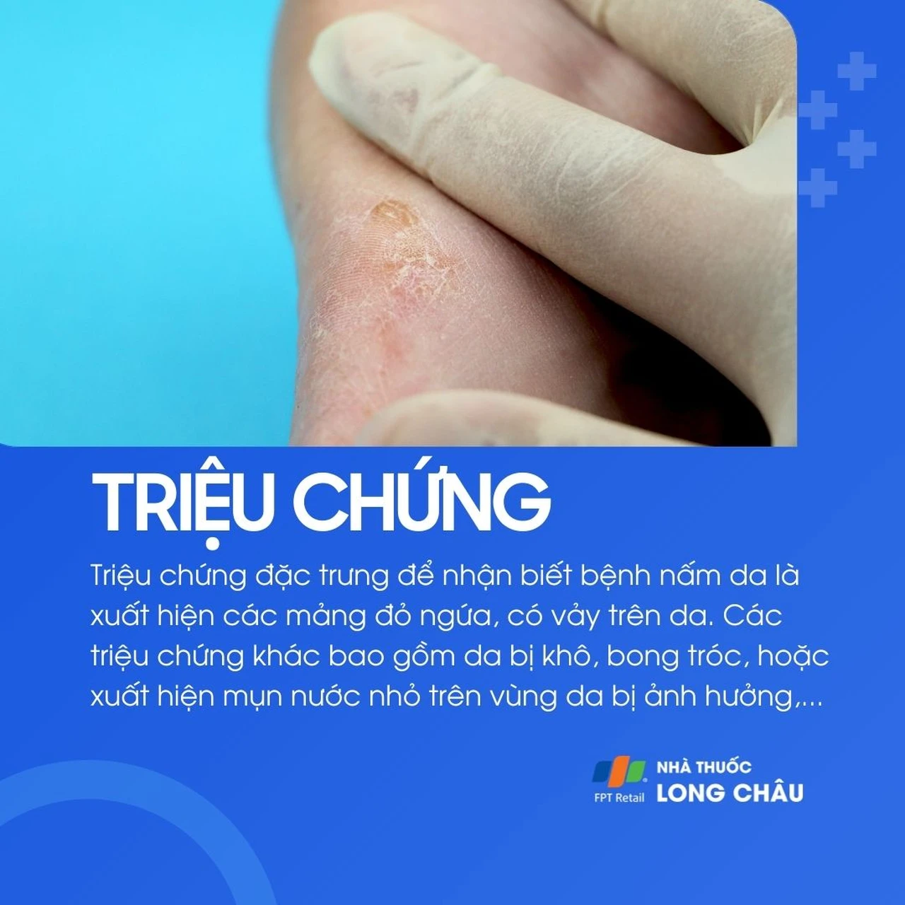 Bệnh thường gây mảng đỏ ngứa, có vảy, da khô, bong tróc hoặc nổi mụn nước nhỏ trên vùng da bị ảnh hưởng