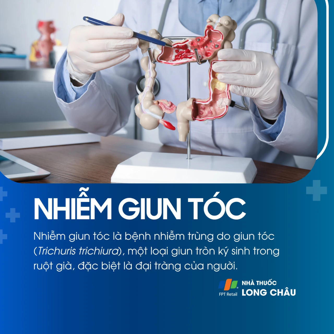 Nhiễm giun tóc 1