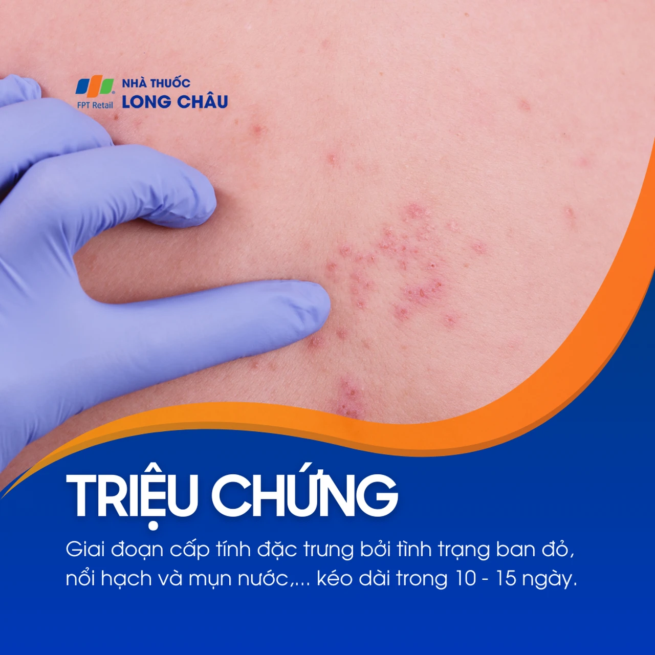 Nhiễm Herpes Zoster 3