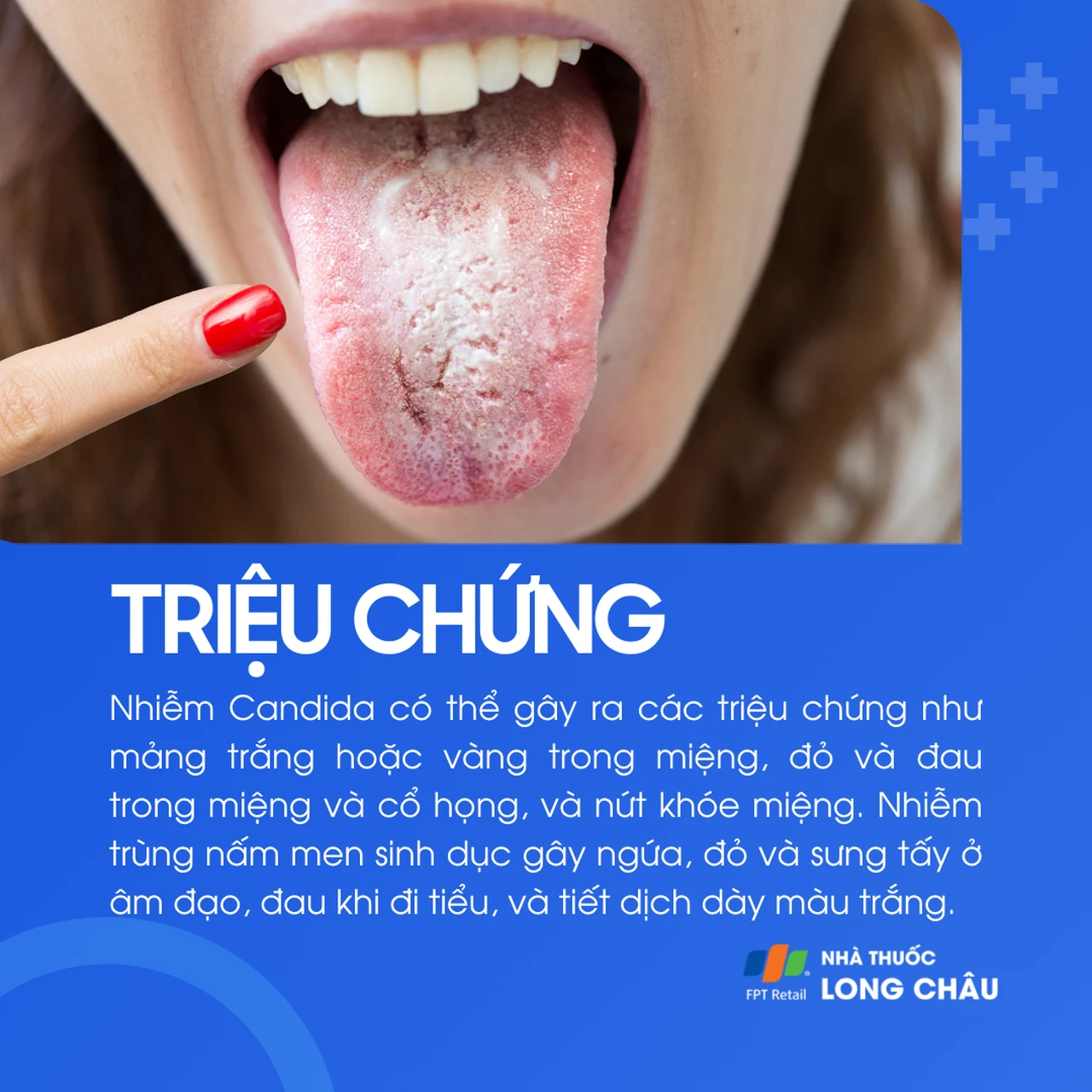 Triệu chứng nhiễm nấm Candida gồm: mảng trắng/vàng trong miệng, đau họng, nứt khóe miệng, ngứa và dịch âm đạo trắng đục