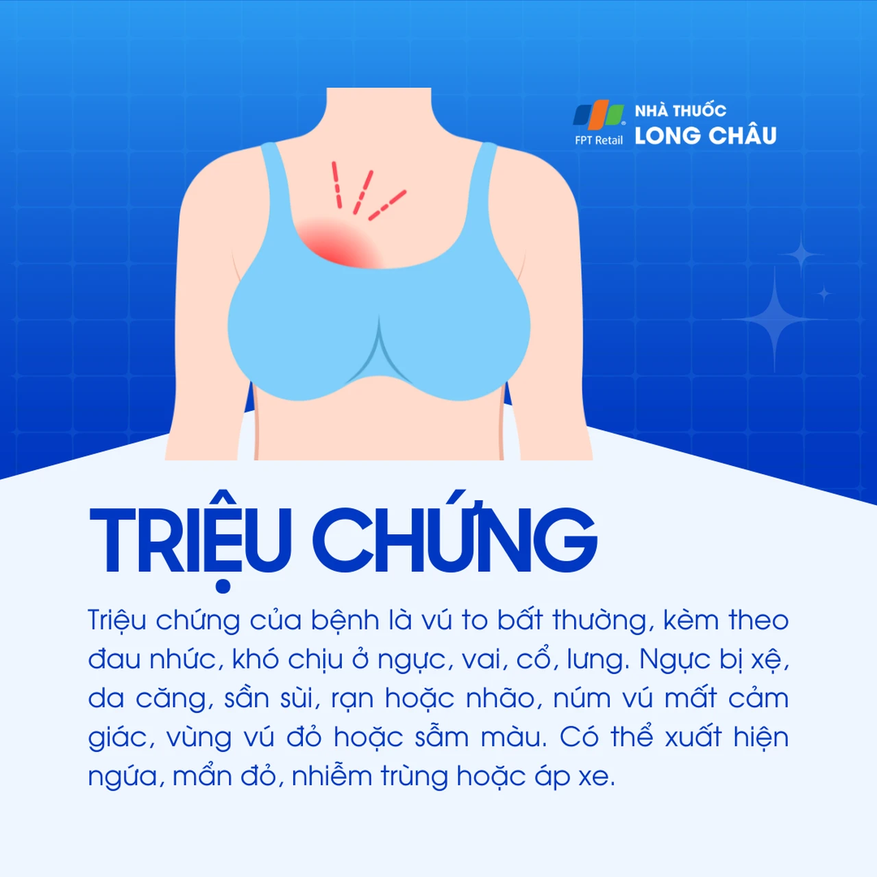 Phì đại tuyến vú 2