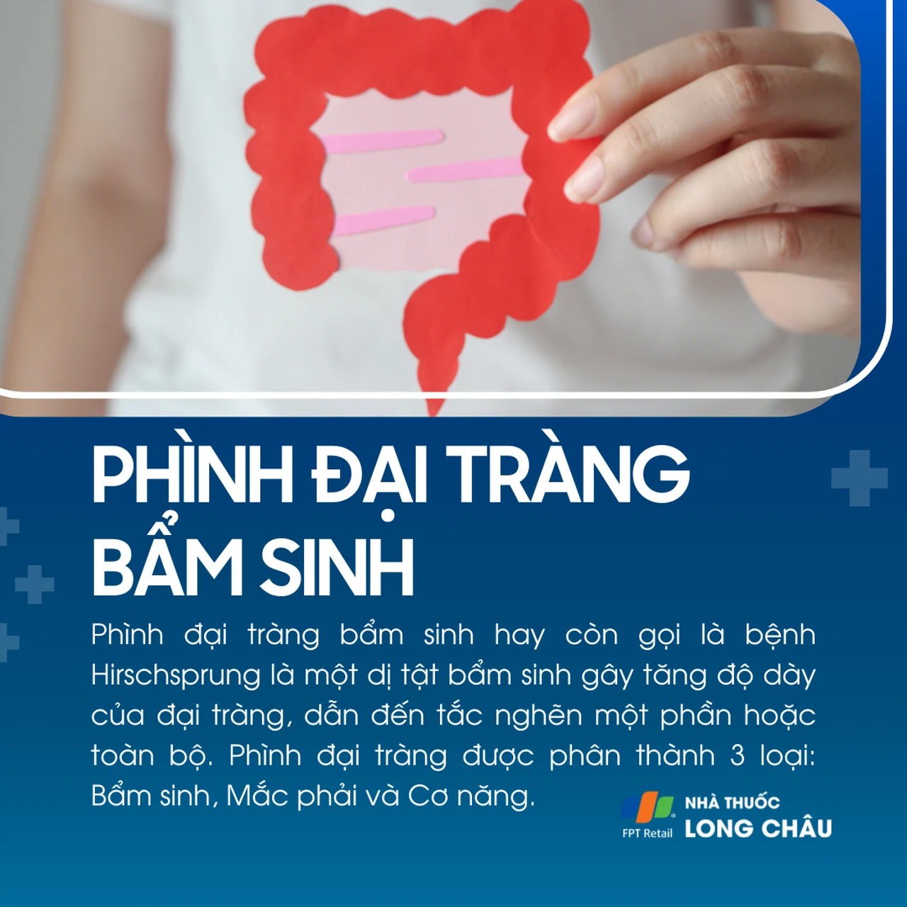 Phình đại tràng bẩm sinh 1