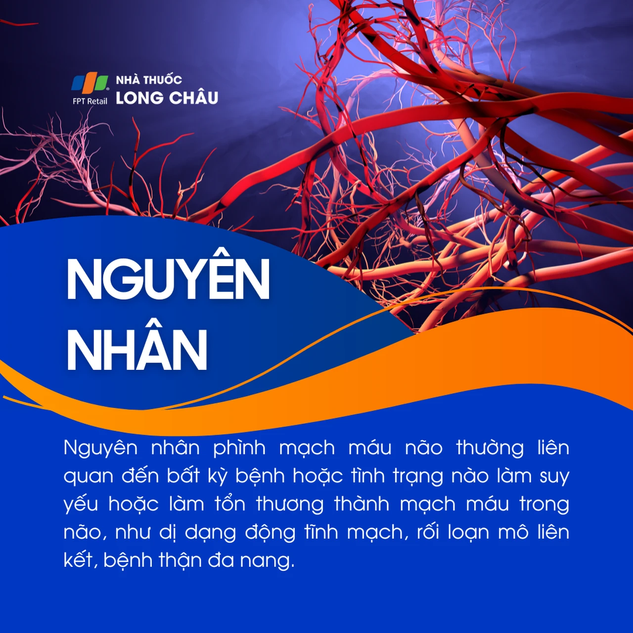 Phình mạch máu não 3