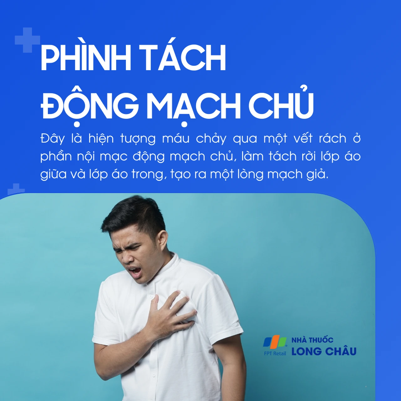 Phình tách động mạch chủ 1