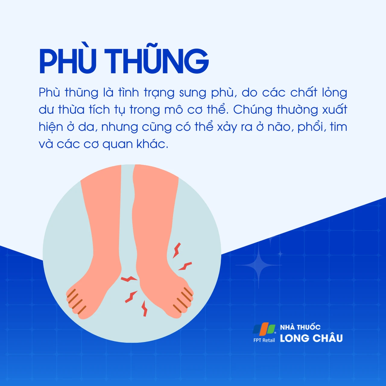 Phù thũng 1