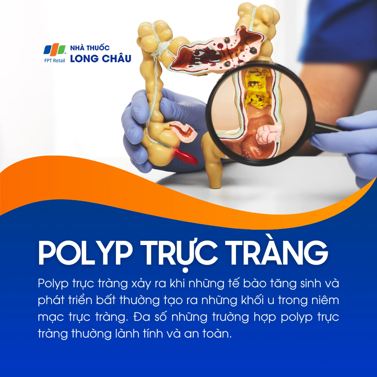 Polyp trực tràng 1