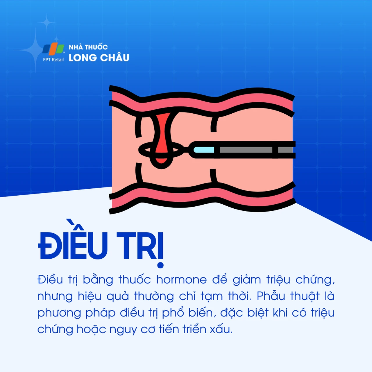 Polyp lòng tử cung 5