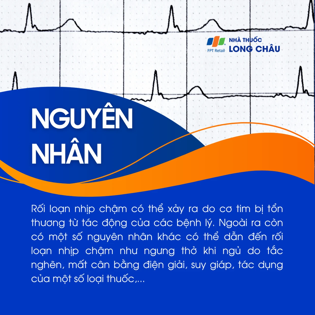 Rối loạn nhịp chậm 3