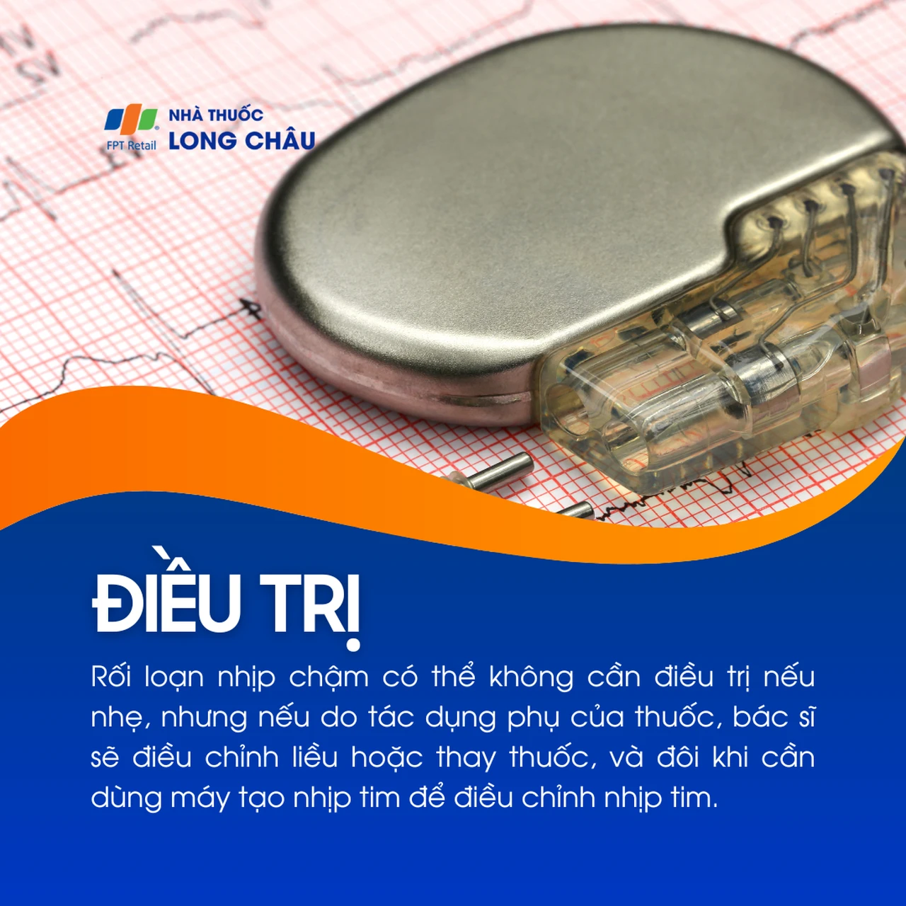 Rối loạn nhịp chậm 5