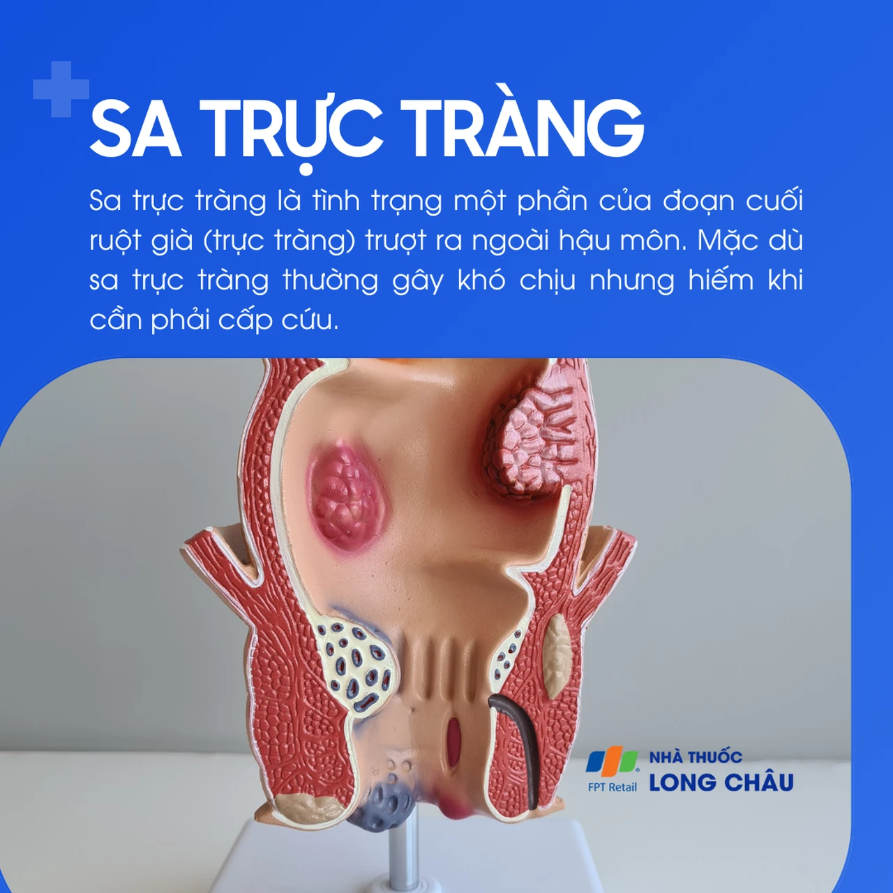 Sa trực tràng 1