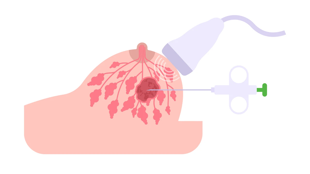 sarcoma mạch máu 2