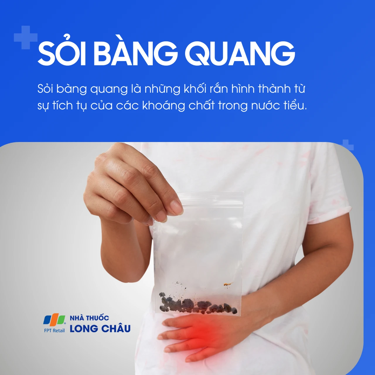 Sỏi bàng quang 1
