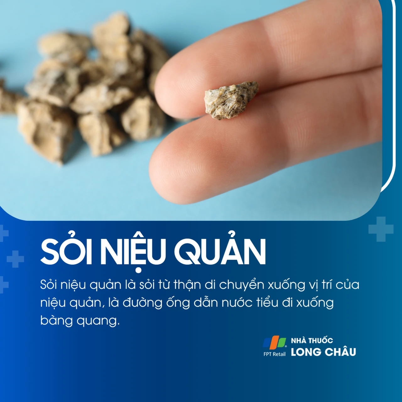 Sỏi niệu quản 1