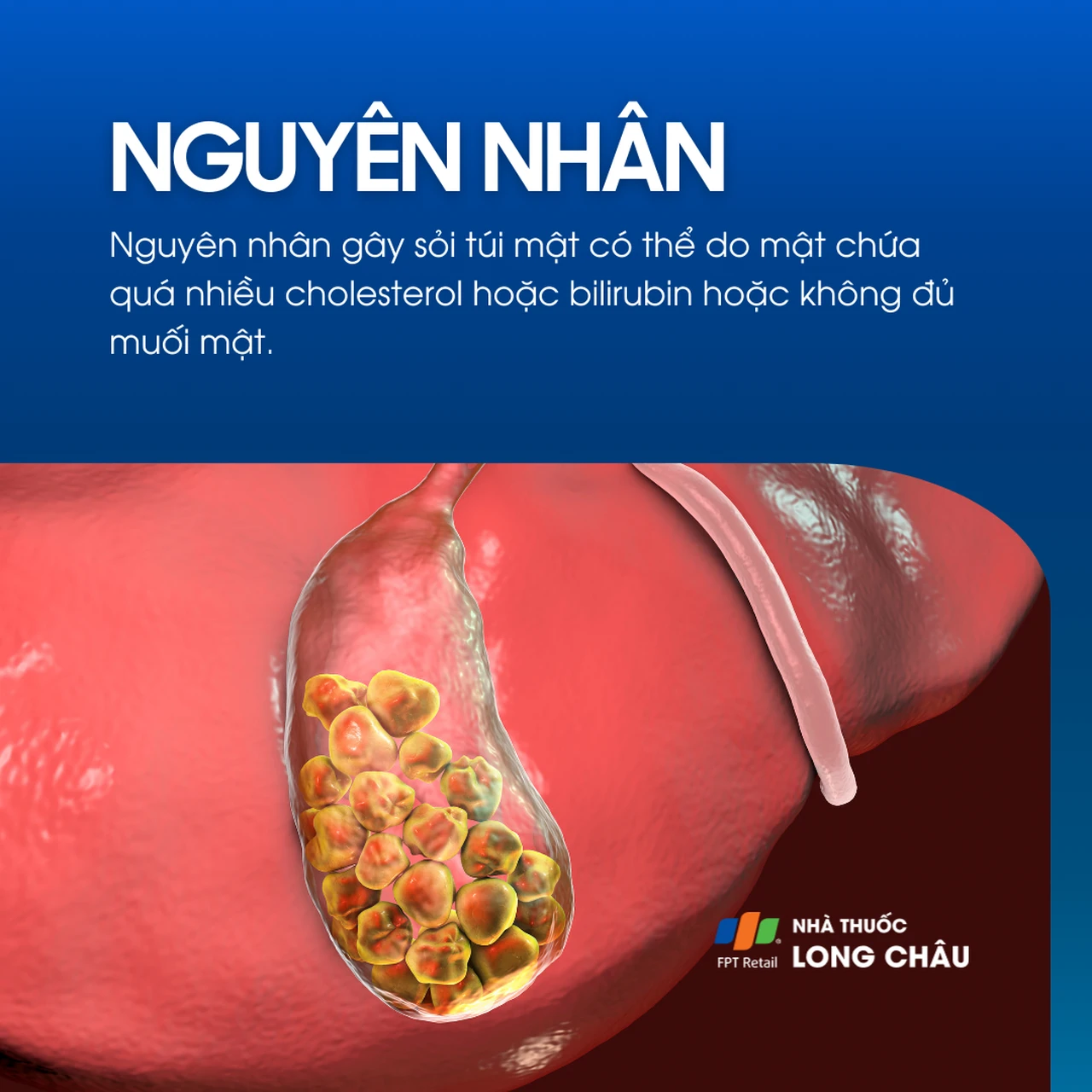 Nguyên nhân gây sỏi túi mật do đâu?