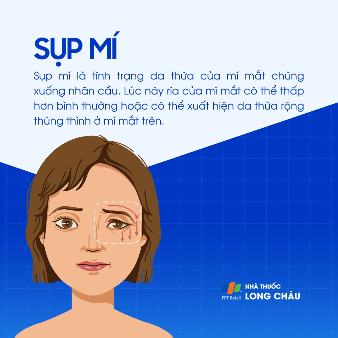 Sụp mí 1