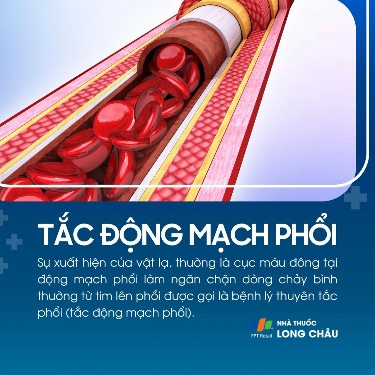 Tắc động mạch phổi 1