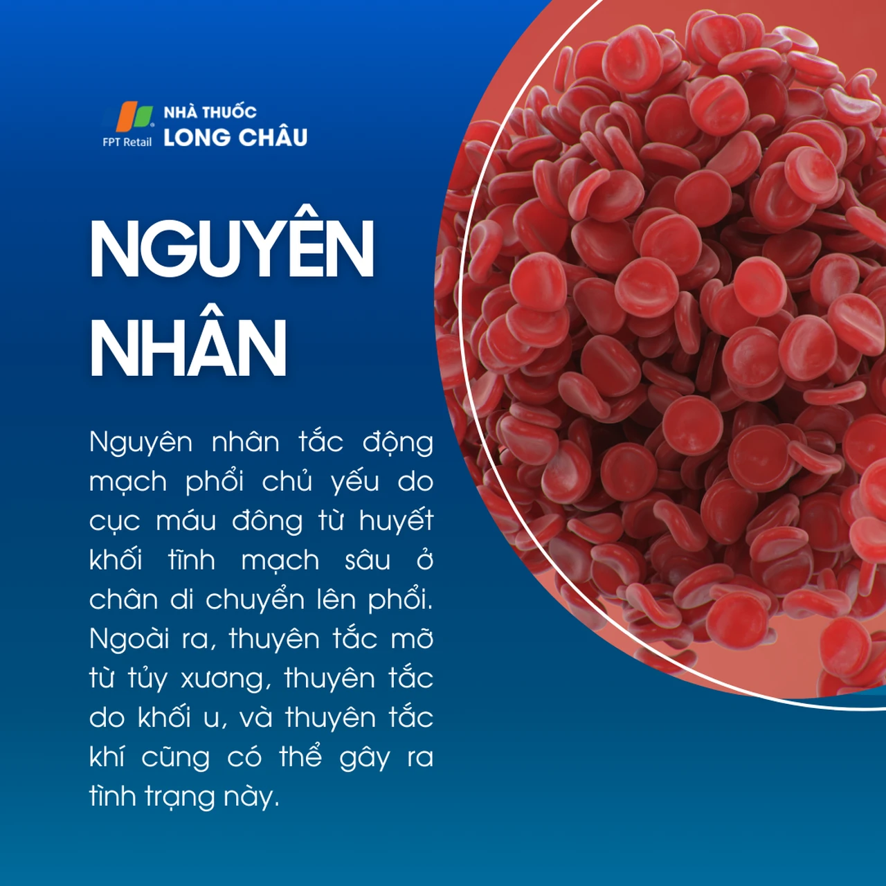 Tắc động mạch phổi 3